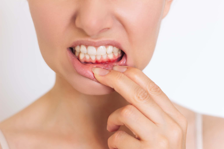 歯周病になったイメージ