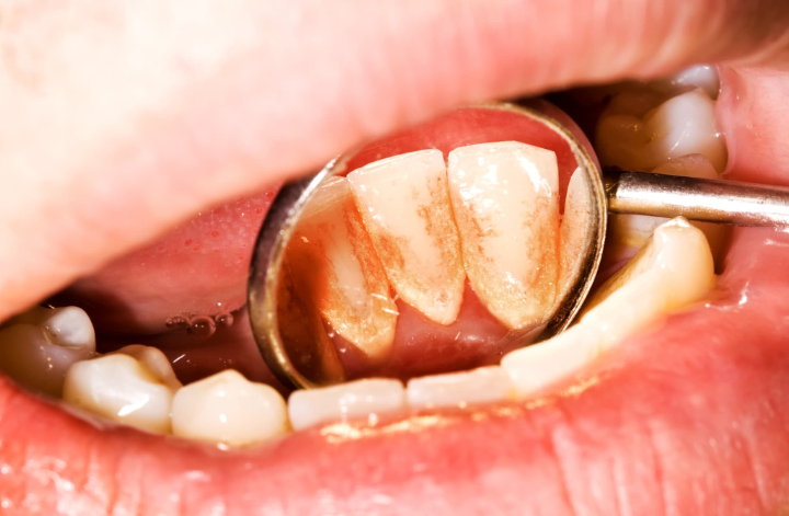 歯石が付着した歯の裏側をうつすデンタルミラー